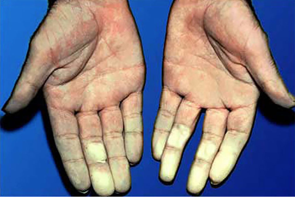 Mixed Connective Tissue Disease Causes, Symptoms, Treatment