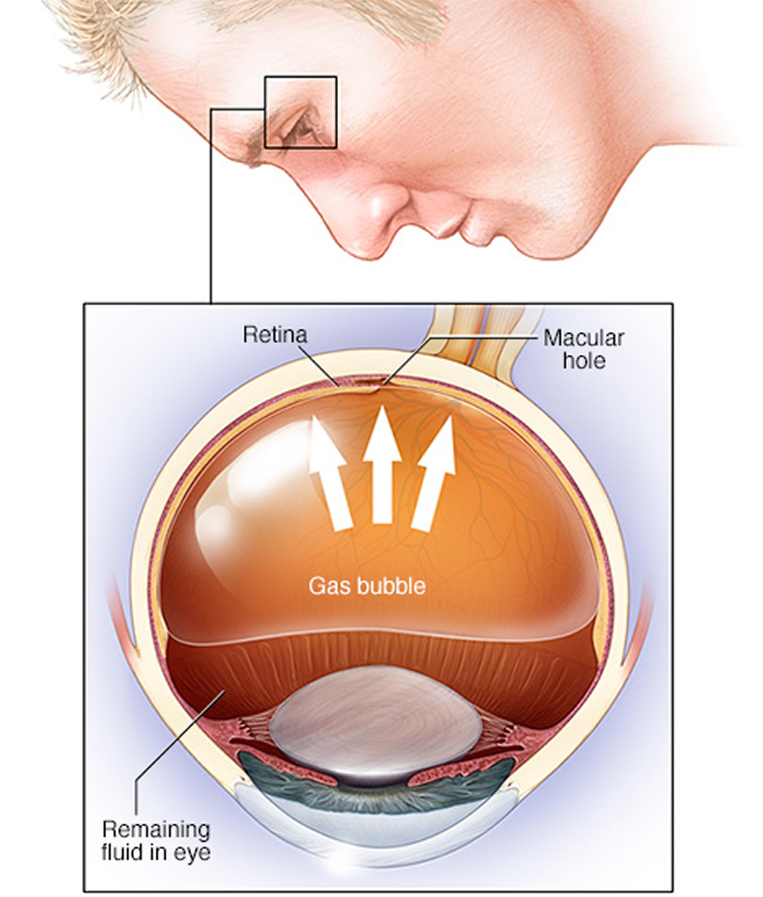 eye retina replacement surgery
