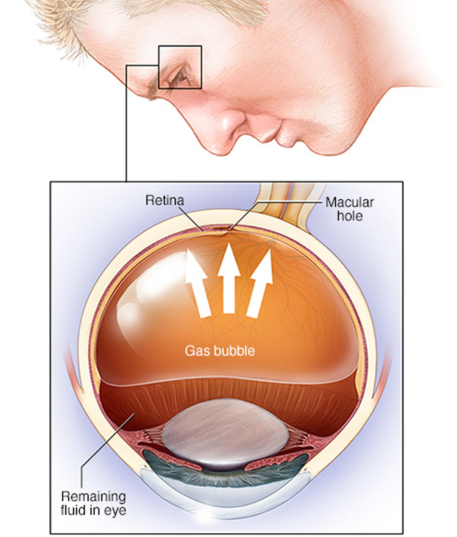 retina detachment surgery and after care elevation