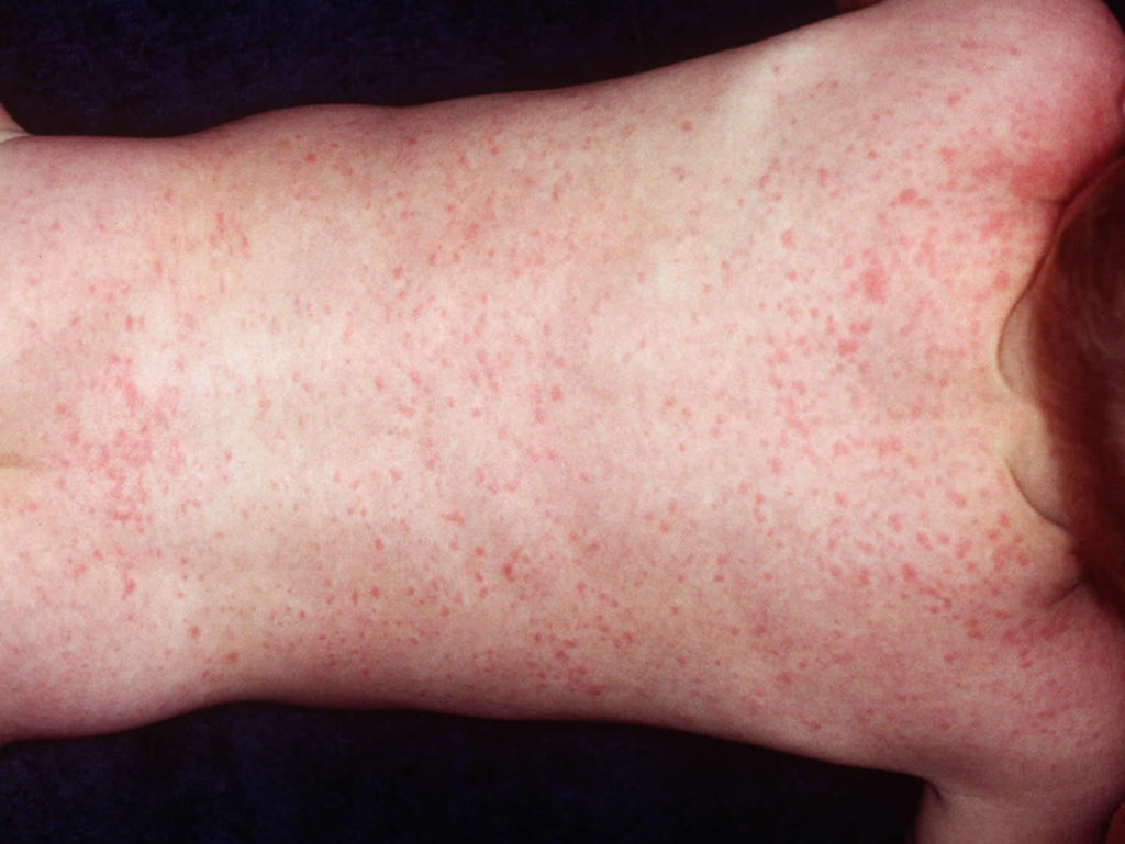 Roseola Causes, Roseola Infantum Symptoms, Rash, Treatment
