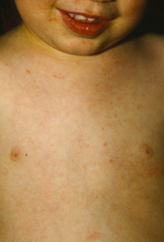 Roseola Causes, Roseola Infantum Symptoms, Rash, Treatment