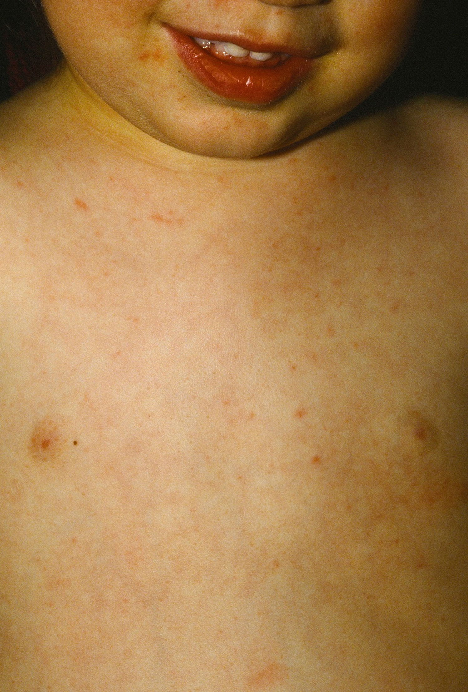 Roseola Causes, Roseola Infantum Symptoms, Rash, Treatment