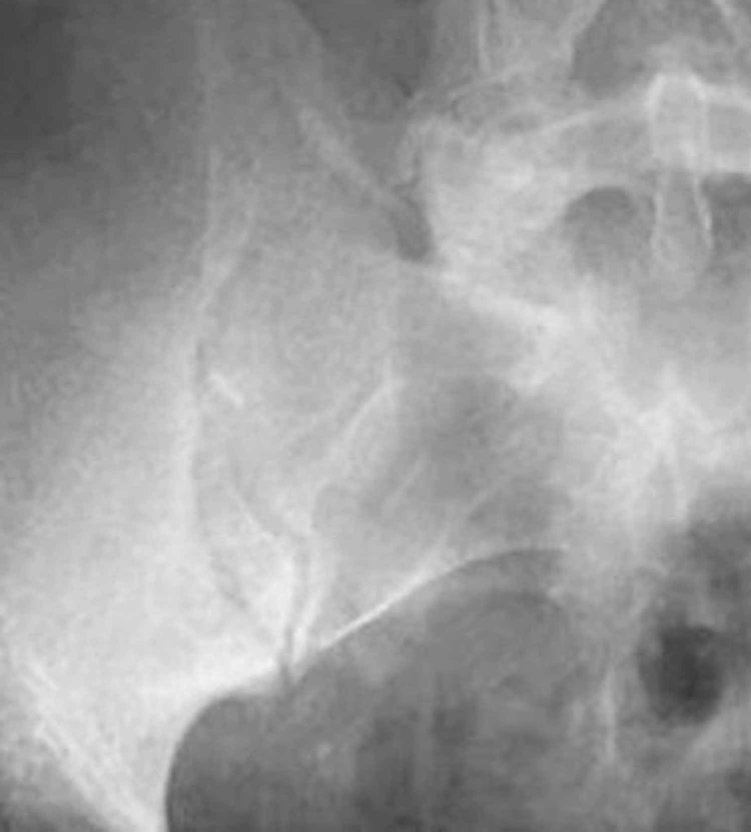 Sacroiliitis Disability Rating 56 - ayqngyp