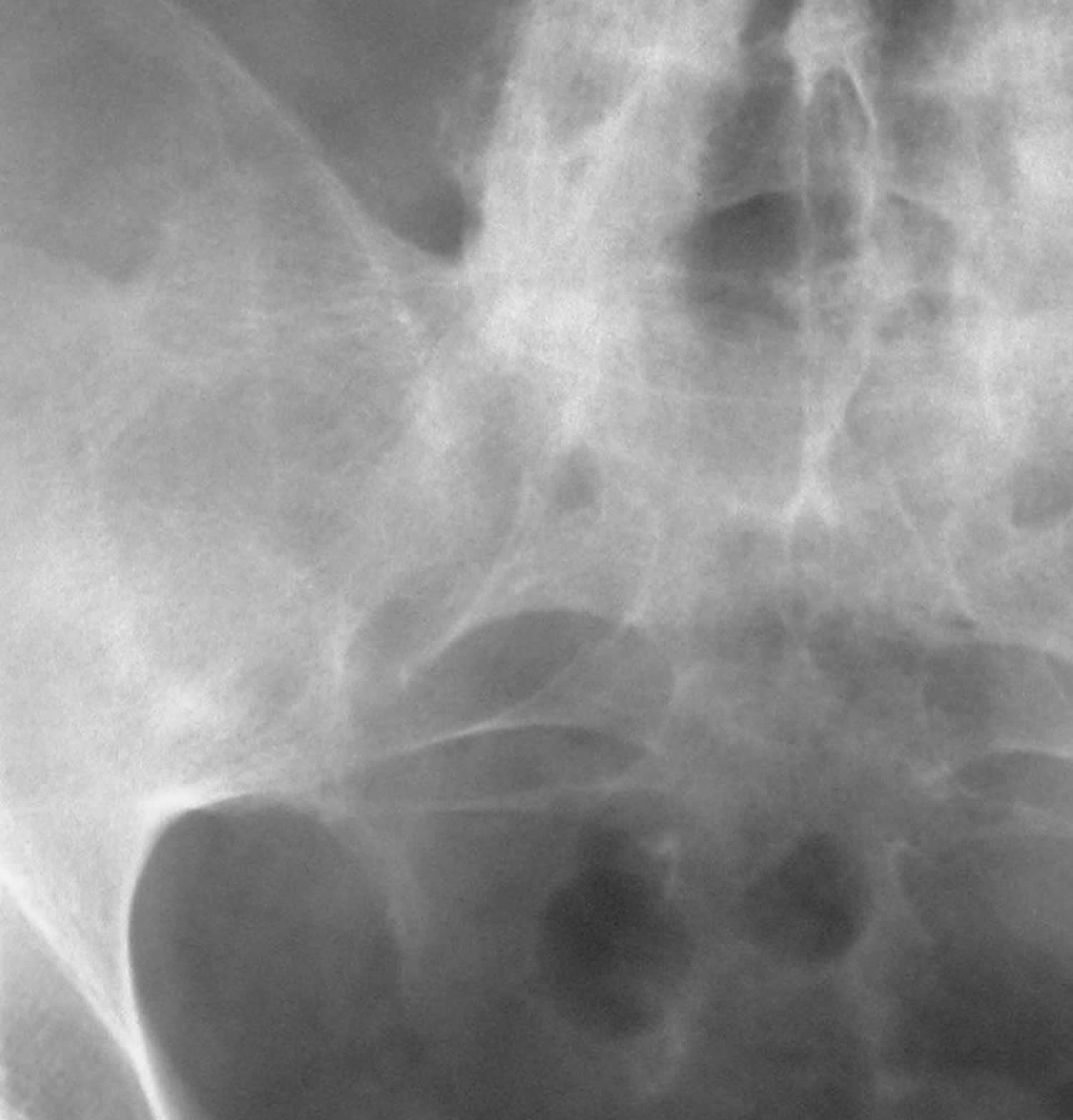 Sacroiliitis Disability Rating 56 - u8sifo4