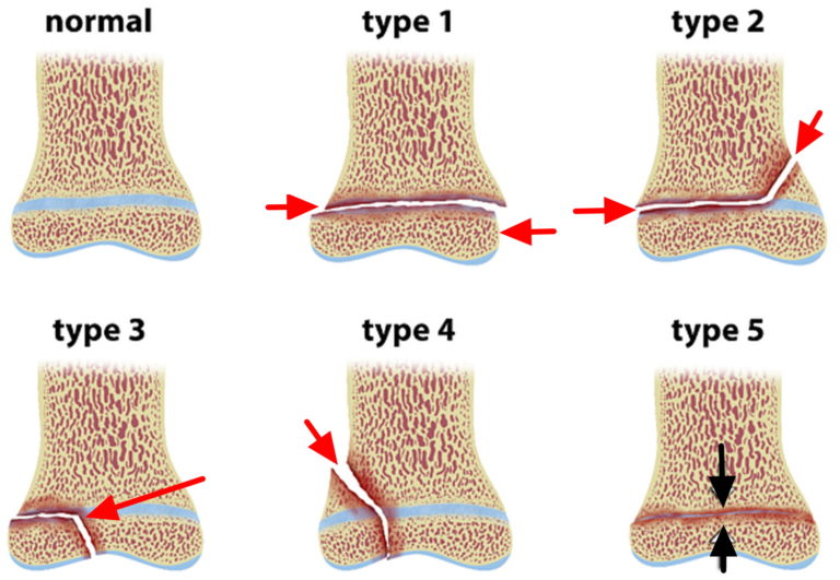 Growth Plate Fracture - Causes, Types, Symptoms,Treatment