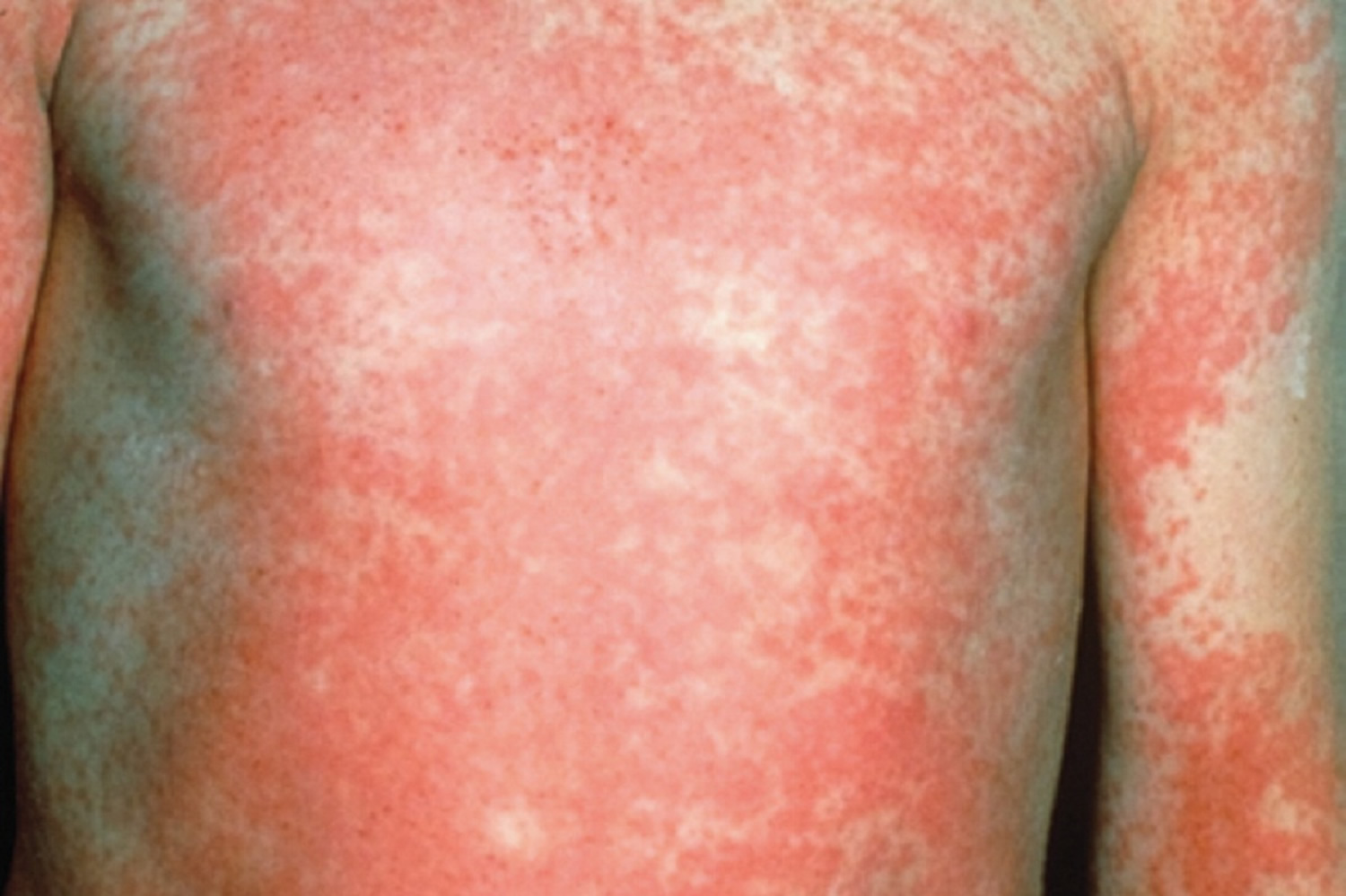 How Long Scarlet Fever Rash Last