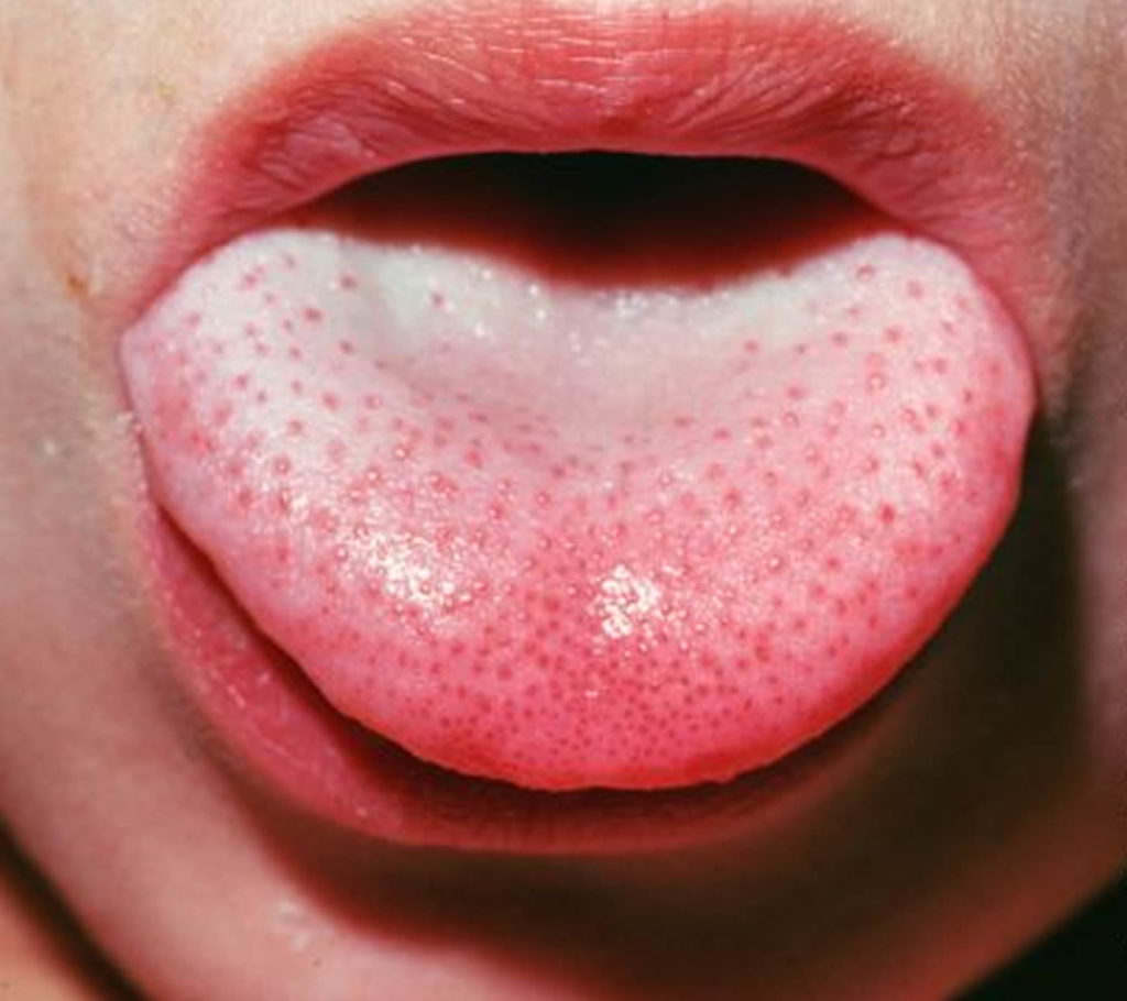 scarlet-fever-causes-symptoms-long-term-effects-treatment