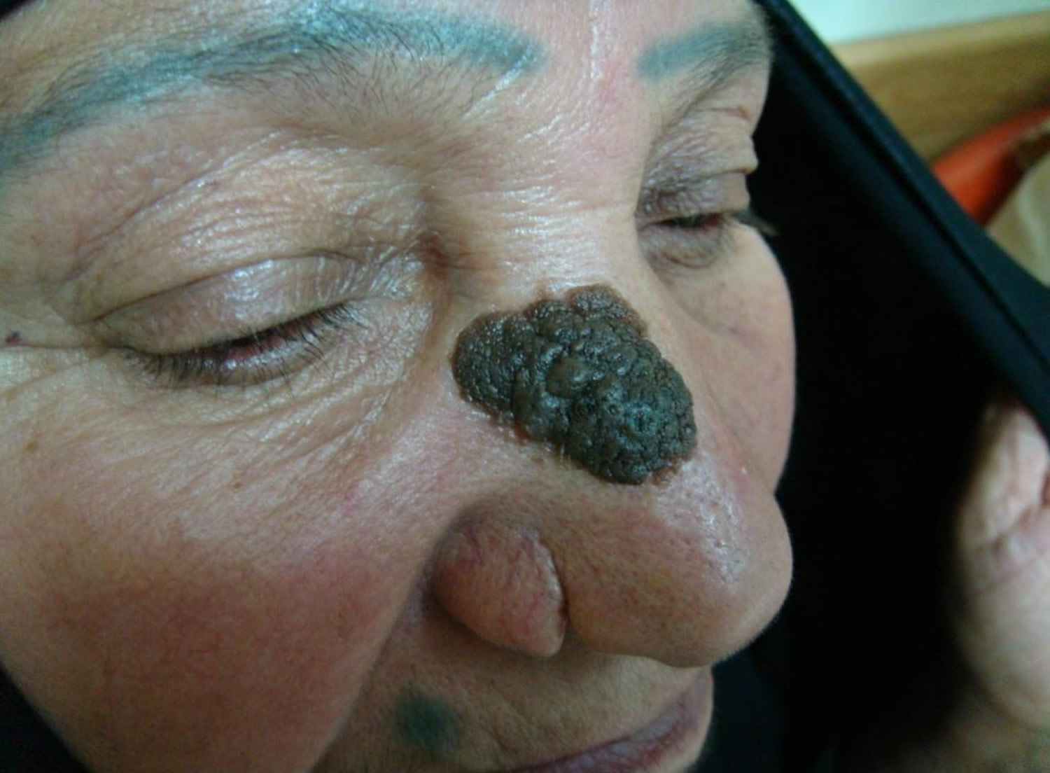 Seborrheic Keratosis Causes Symptoms Home Treatment 