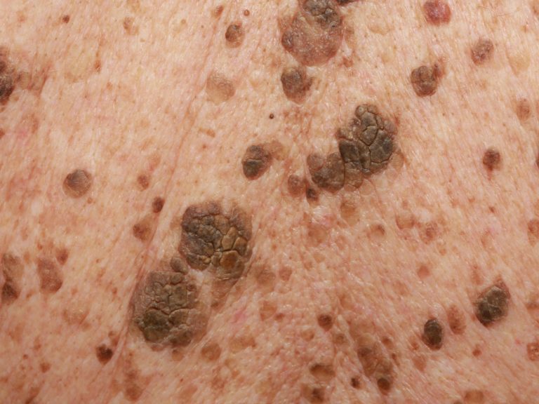 Seborrheic Keratosis - Causes, Symptoms, Home Treatment