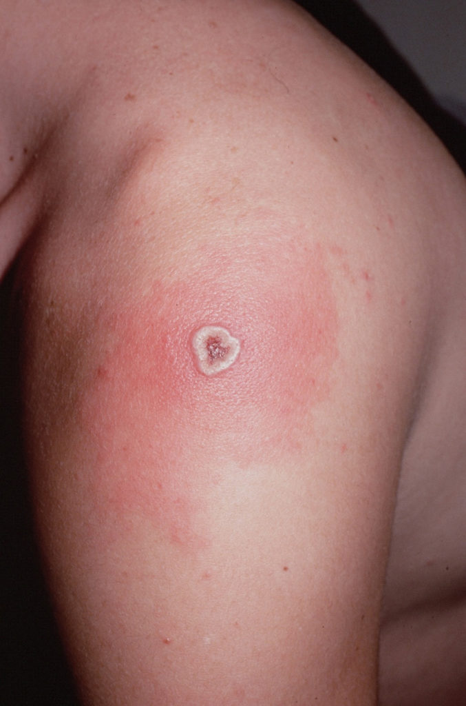 Smallpox - Symptoms, Vaccine, Diangosis, Treatment