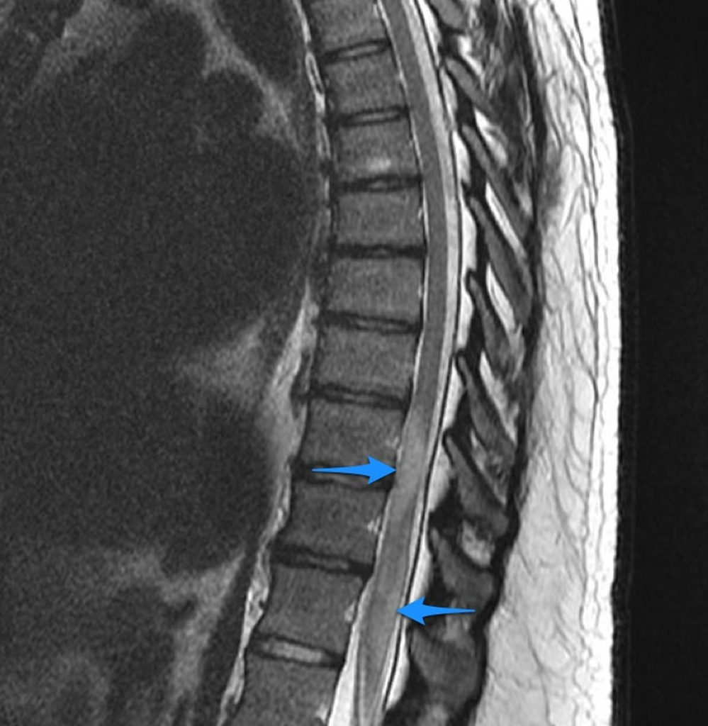 Transverse Myelitis - Causes, Symptoms, Prognosis, Treatment