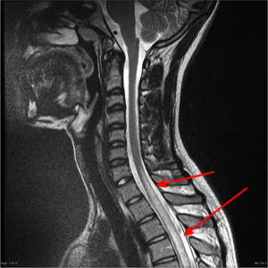 Transverse Myelitis - Causes, Symptoms, Prognosis, Treatment