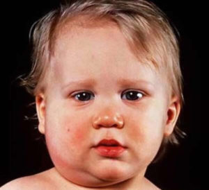 Mumps - Symptoms, What Mumps Look Like, Vaccine & Treatment