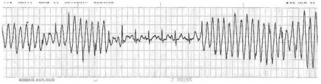 Tachycardia - Causes, Signs, Symptoms, Types, Diagnosis & Treatment