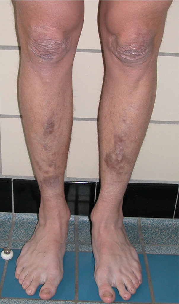 EhlersDanlos Syndrome Causes, Types, Symptoms, Treatment