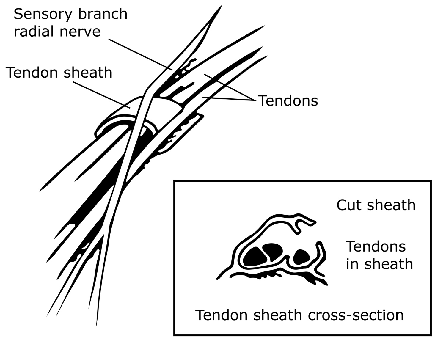 de quervain syndrome surgery
