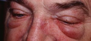 Polymyositis - Causes, Symptoms, Prognosis, Diagnosis, Treatment