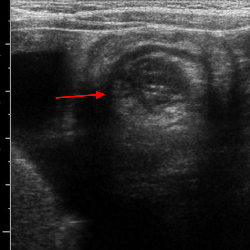 Intussusception Causes, Symptoms, Diagnosis, Treatment