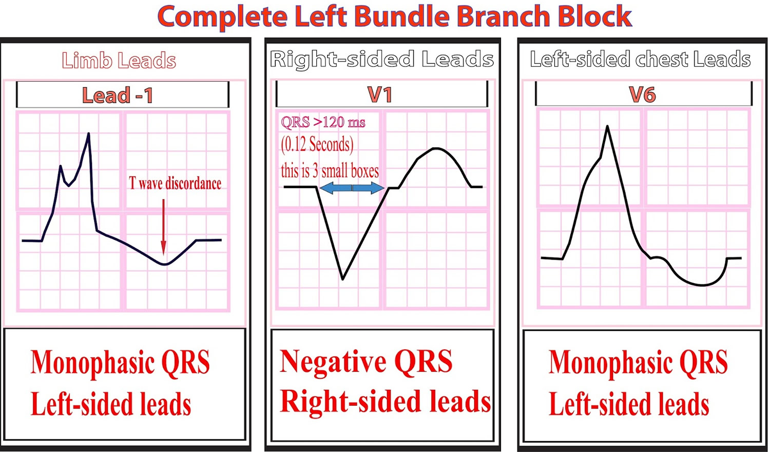 Bundle Branch Block Causes Symptoms Diagnosis Treatment   Left Bundle Branch Block ECG 1 