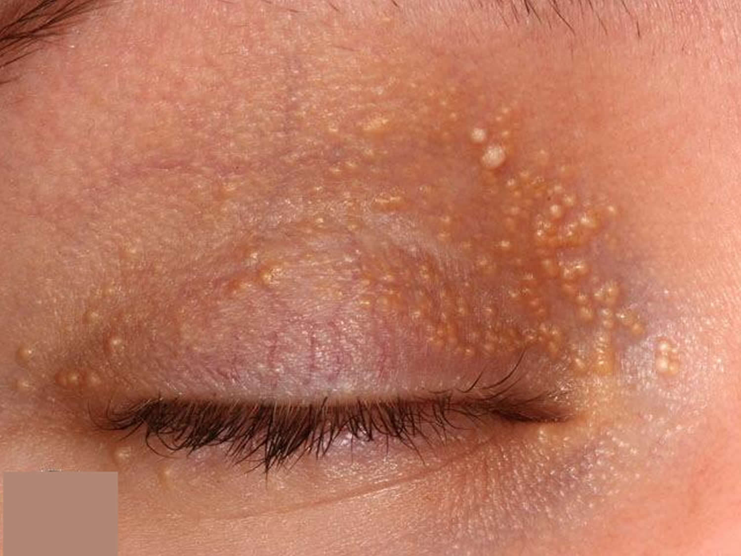 What Causes Milia On Eyelids