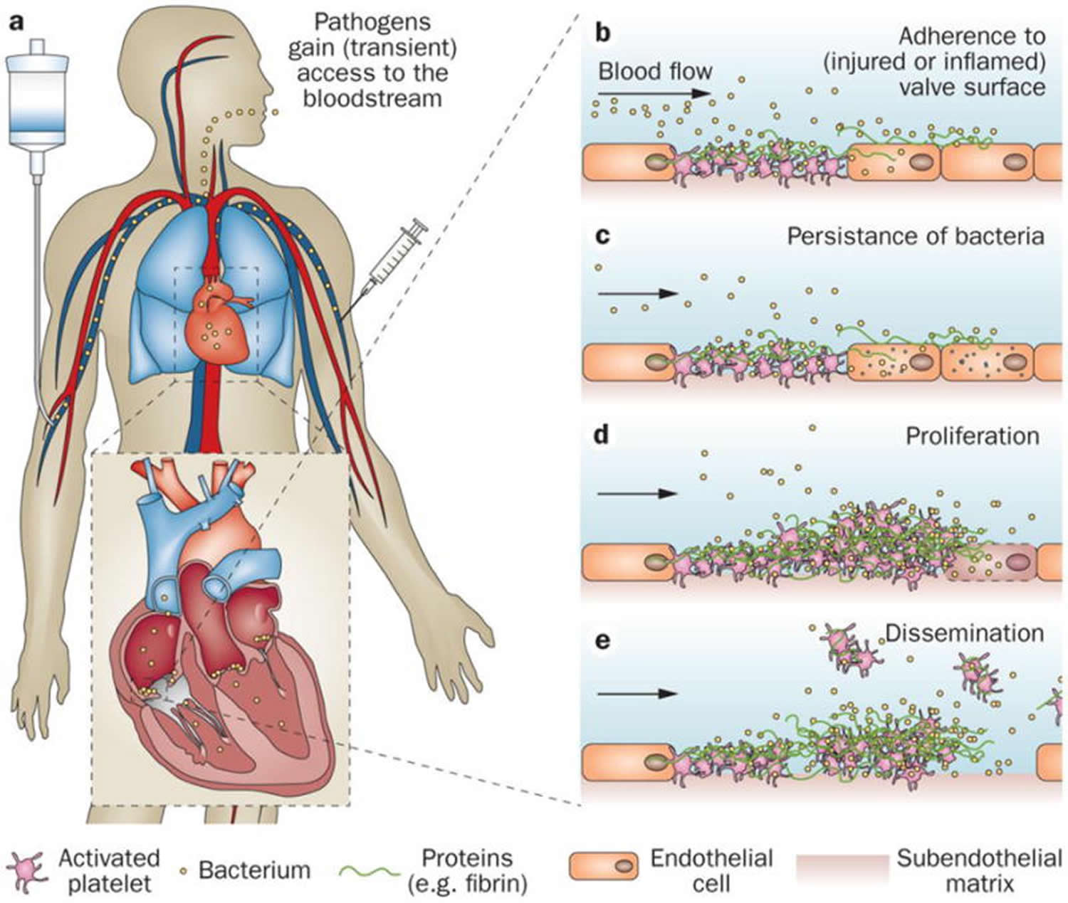 Infective Endocarditis Causes Signs Symptoms Diagnosis Treatment