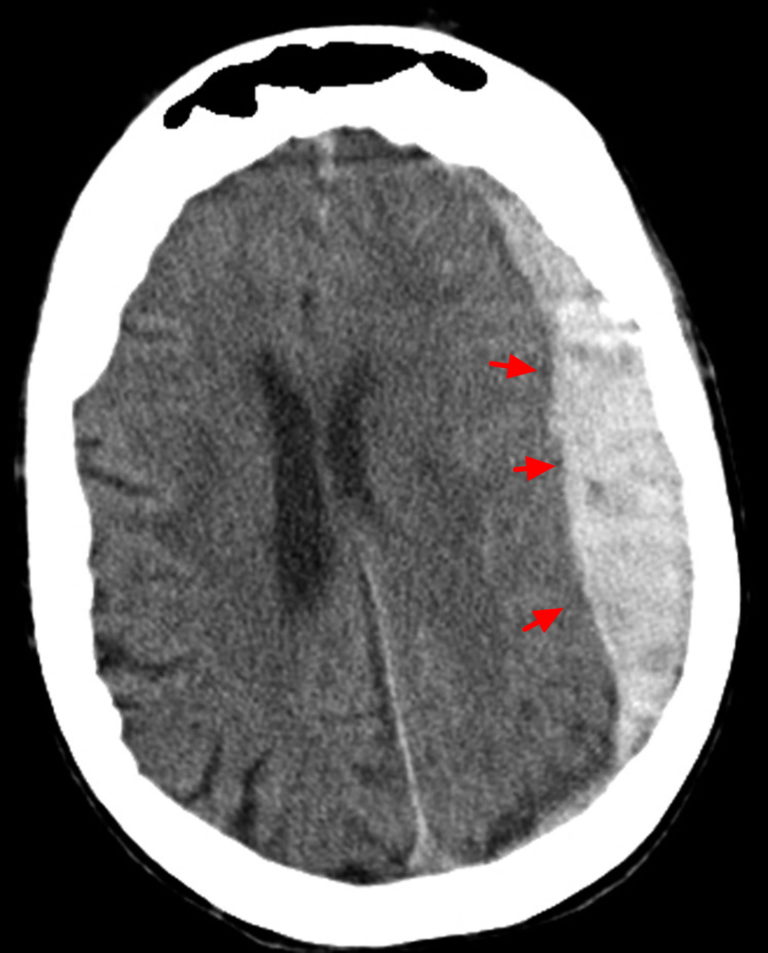 Intracranial Hemorrhage - Cause, Symptoms, Diagnosis, Treatment