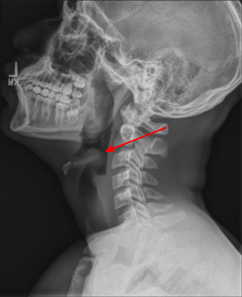 Epiglottitis - Causes, Symptoms, Diagnosis, Treatment