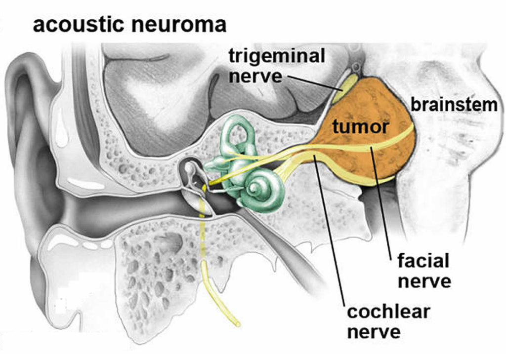 Acoustic Neuroma Causes, Symptoms, Diagnosis, Treatment