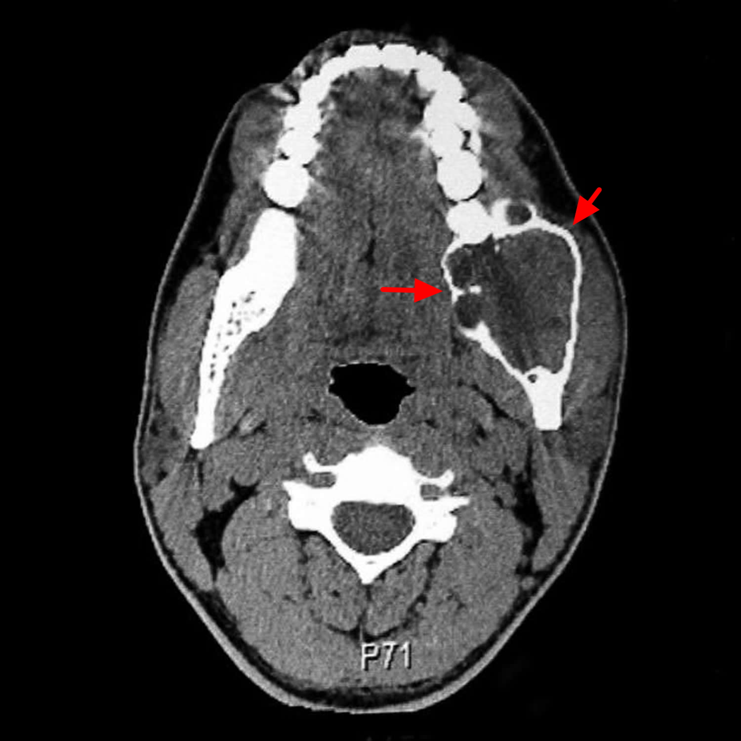 Ameloblastoma Histology Radiology Surgery And Treatment