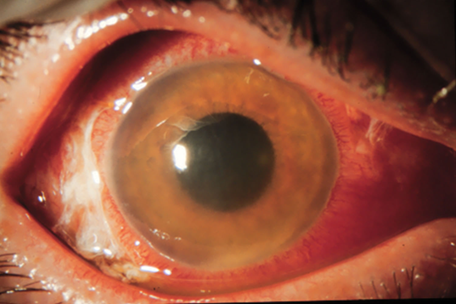 Uveitis, Uveitis Eye - Causes, Types, Symptoms, Diagnosis, Treatment