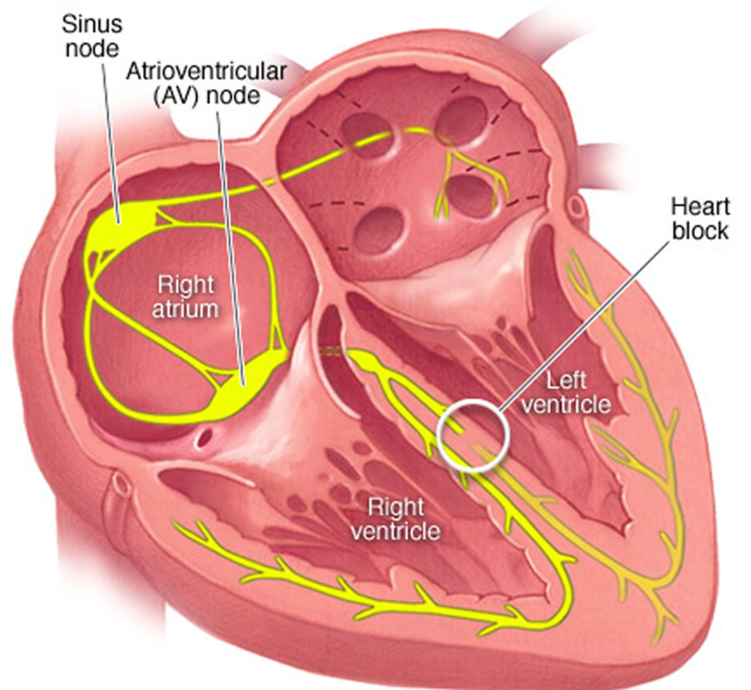 medial-bundle-branch-block