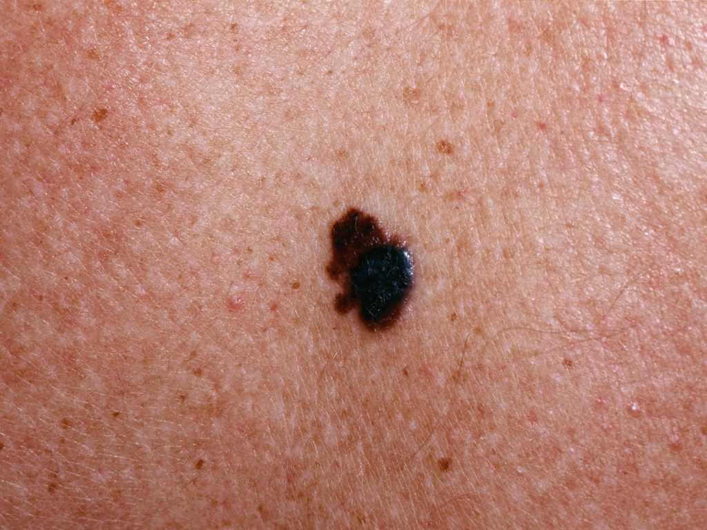 Skin Cancer - Types, Symptoms - Melanoma & Treatment