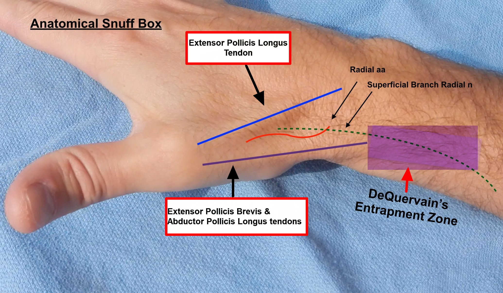 De Quervains Tenosynovitis Causes Symptoms Test Exercise Surgery 4608