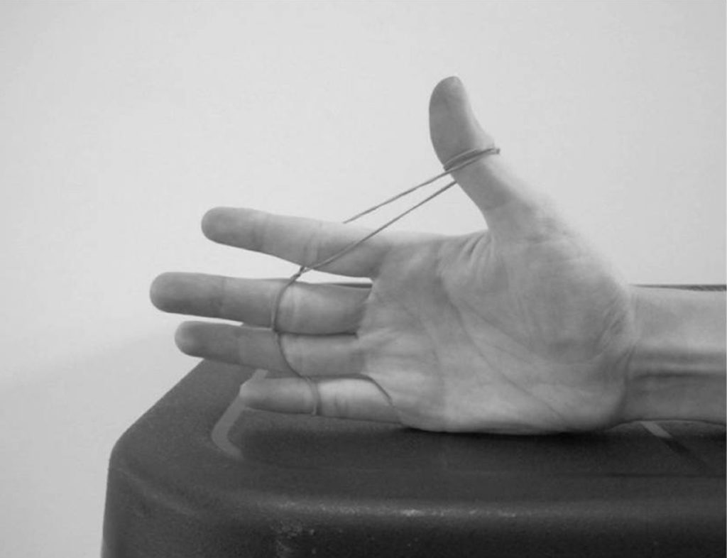 De Quervain syndrome causes, symptoms, diagnosis, treatment, exercises