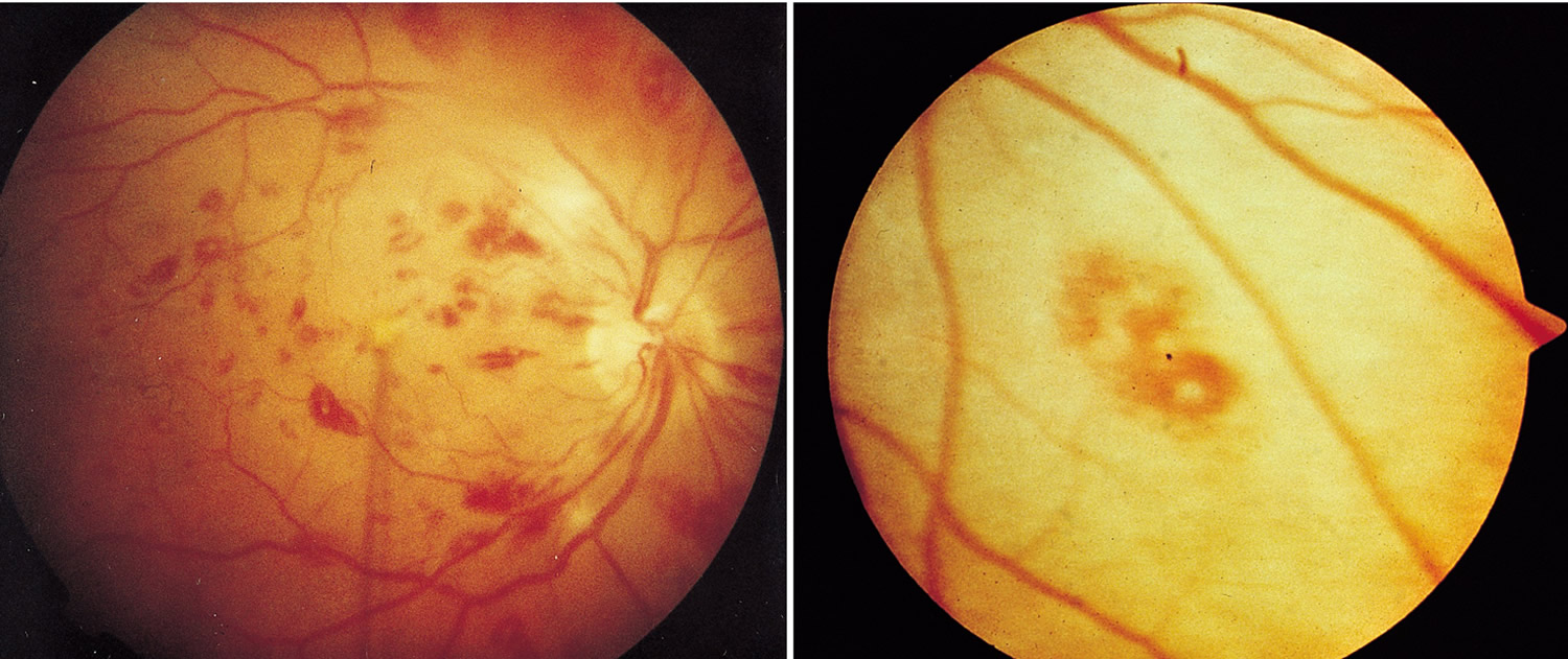 Infective Endocarditis Causes Signs Symptoms Diagnosis And Treatment