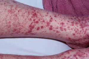 Henoch Schonlein Purpura - Causes, Symptoms, Prognosis & Treatment