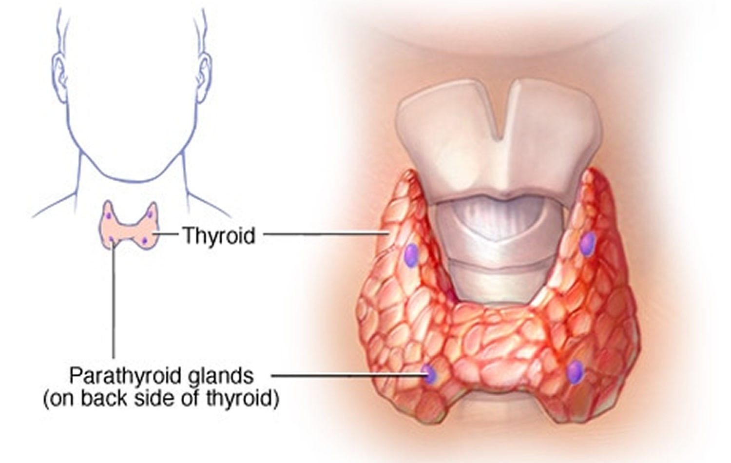 hypoparathyroidism