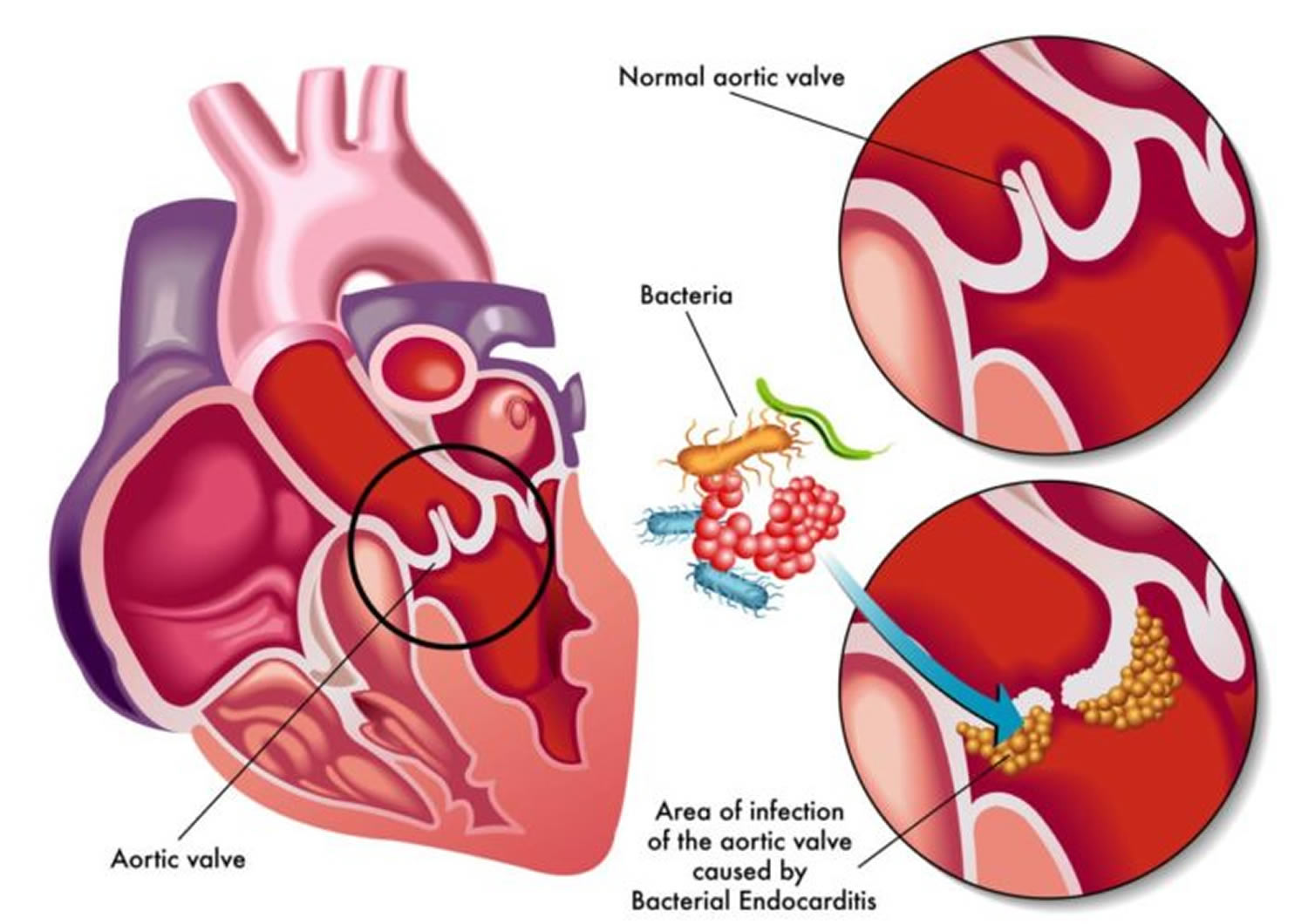 Infective Endocarditis Causes Signs Symptoms Diagnosis And Treatment 6327