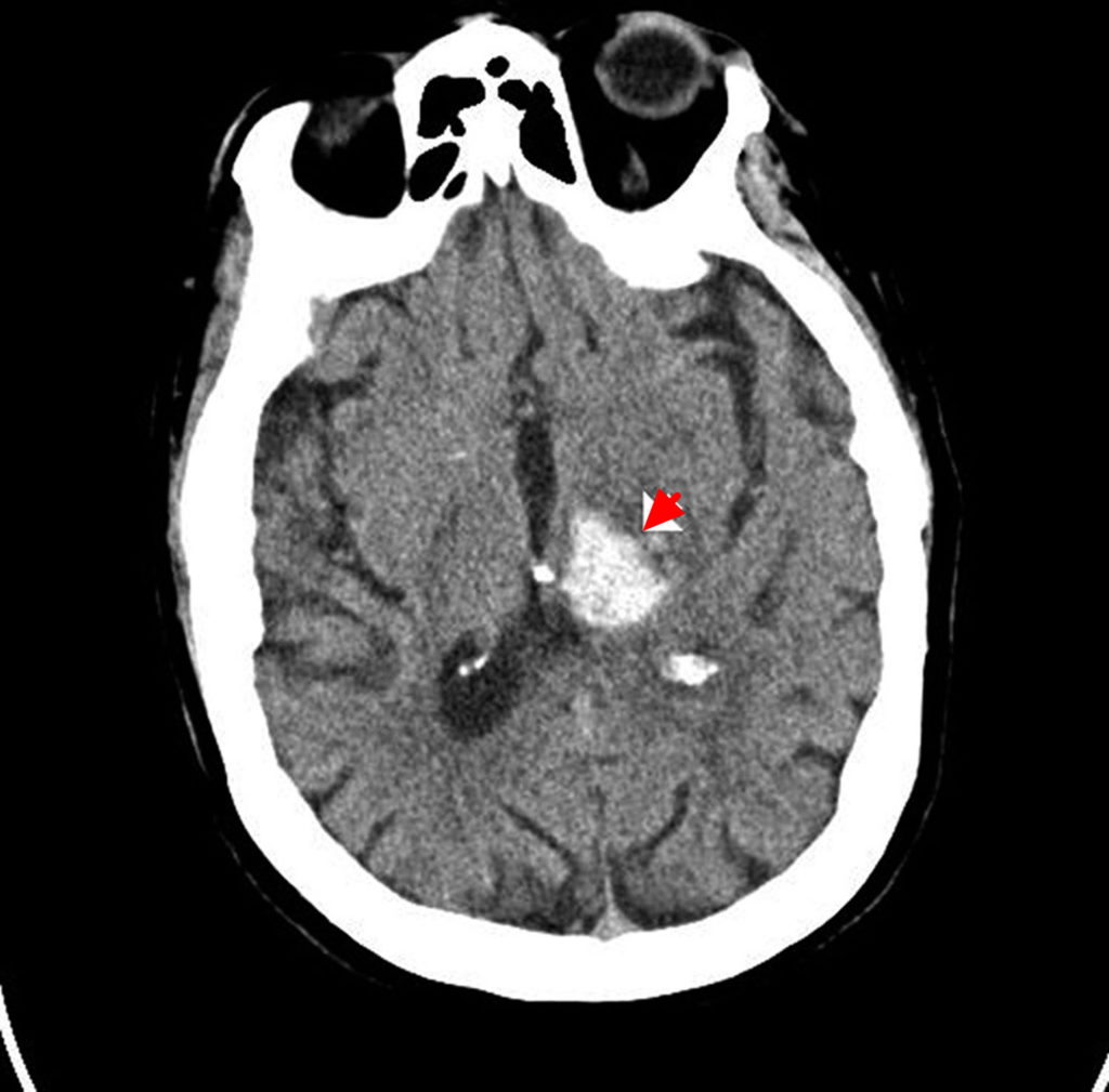 Intracranial Hemorrhage Cause, Symptoms, Diagnosis, Treatment