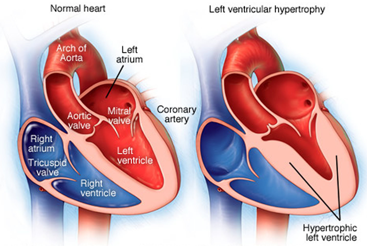 What Does Left Ventricular Hypertrophy Cause