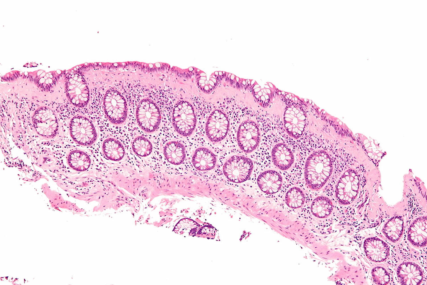 microscopic colitis