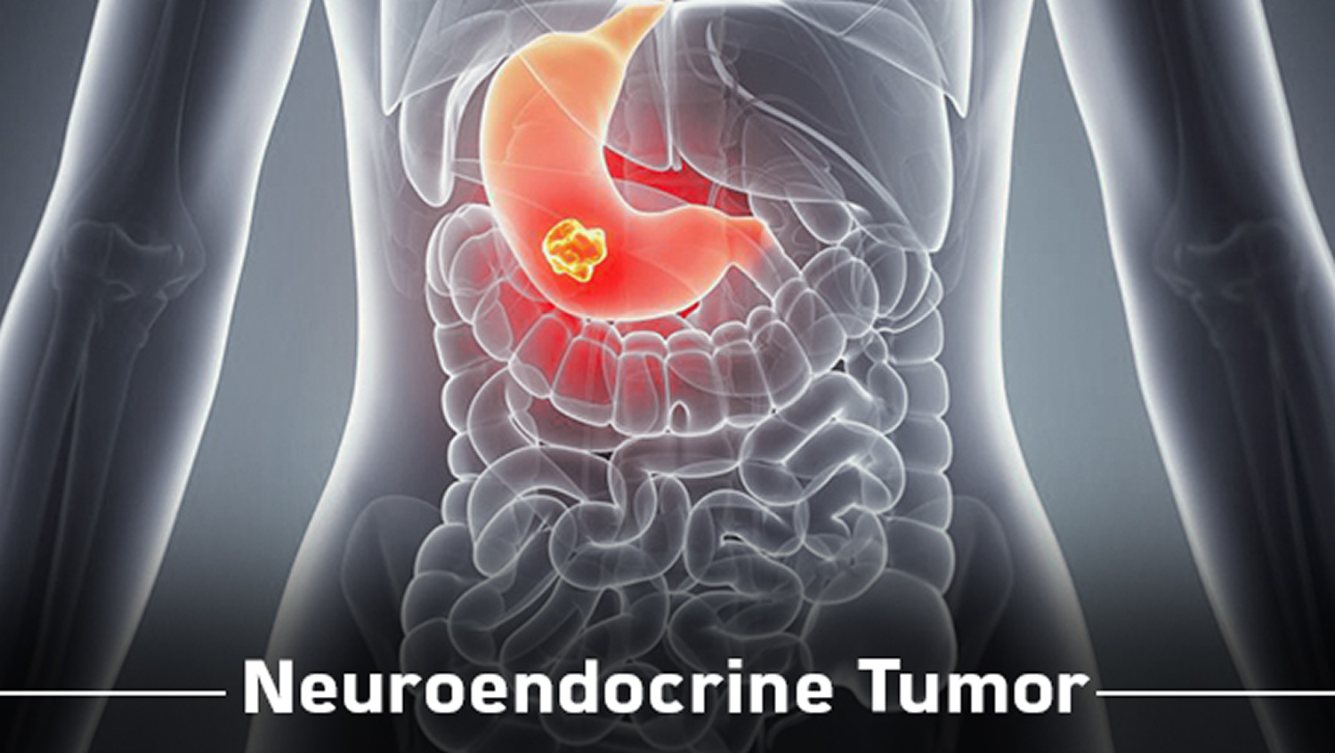 cancer with neuroendocrine tumors