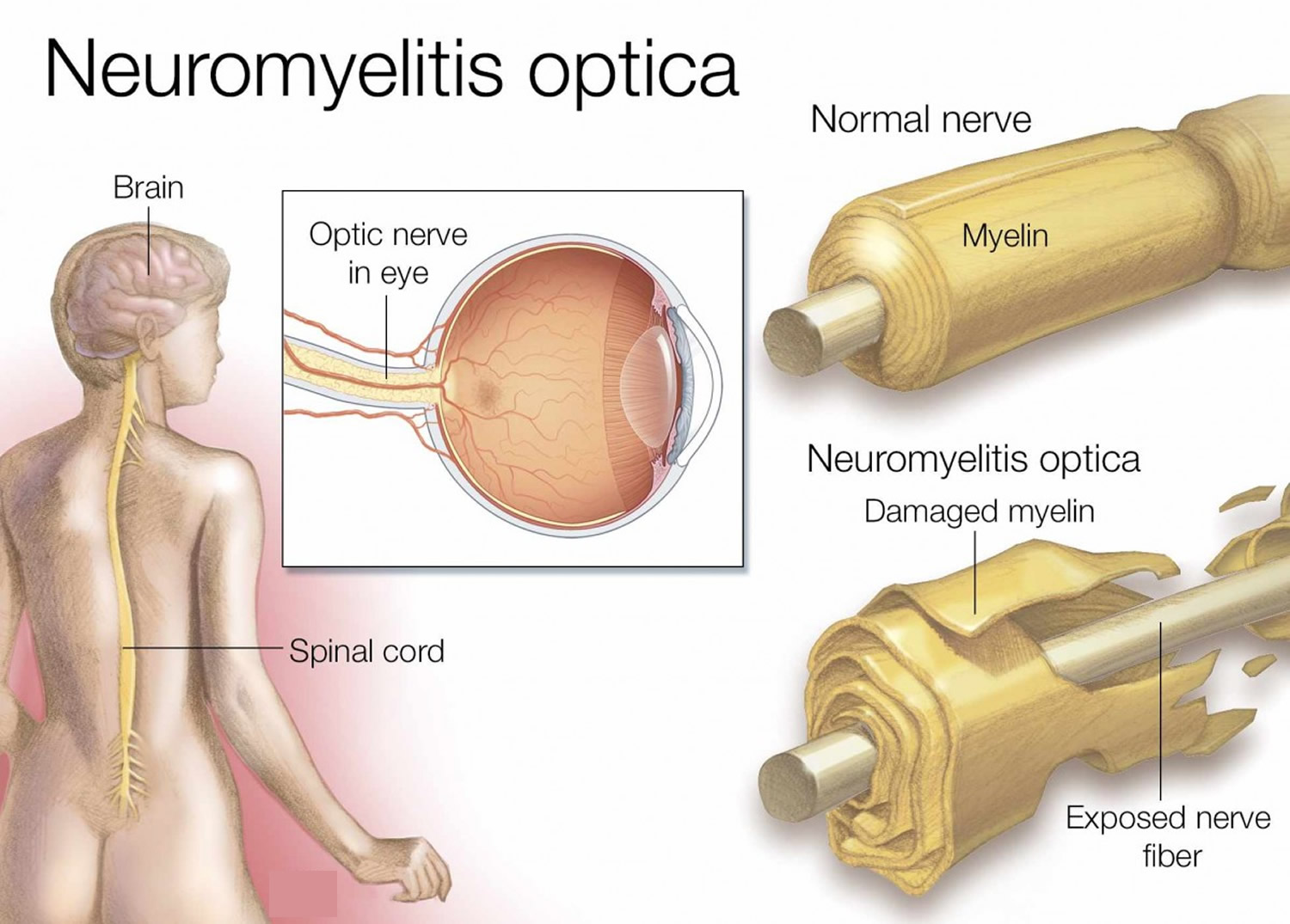 Neuromielitis optica: gejala dan pengobatan