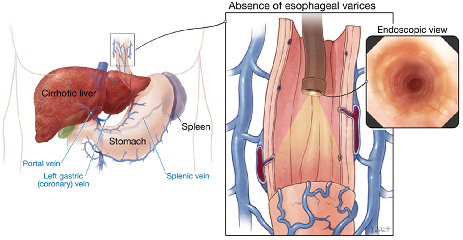 What Is Esophageal Varices In Patients With Liver Cirrhosis