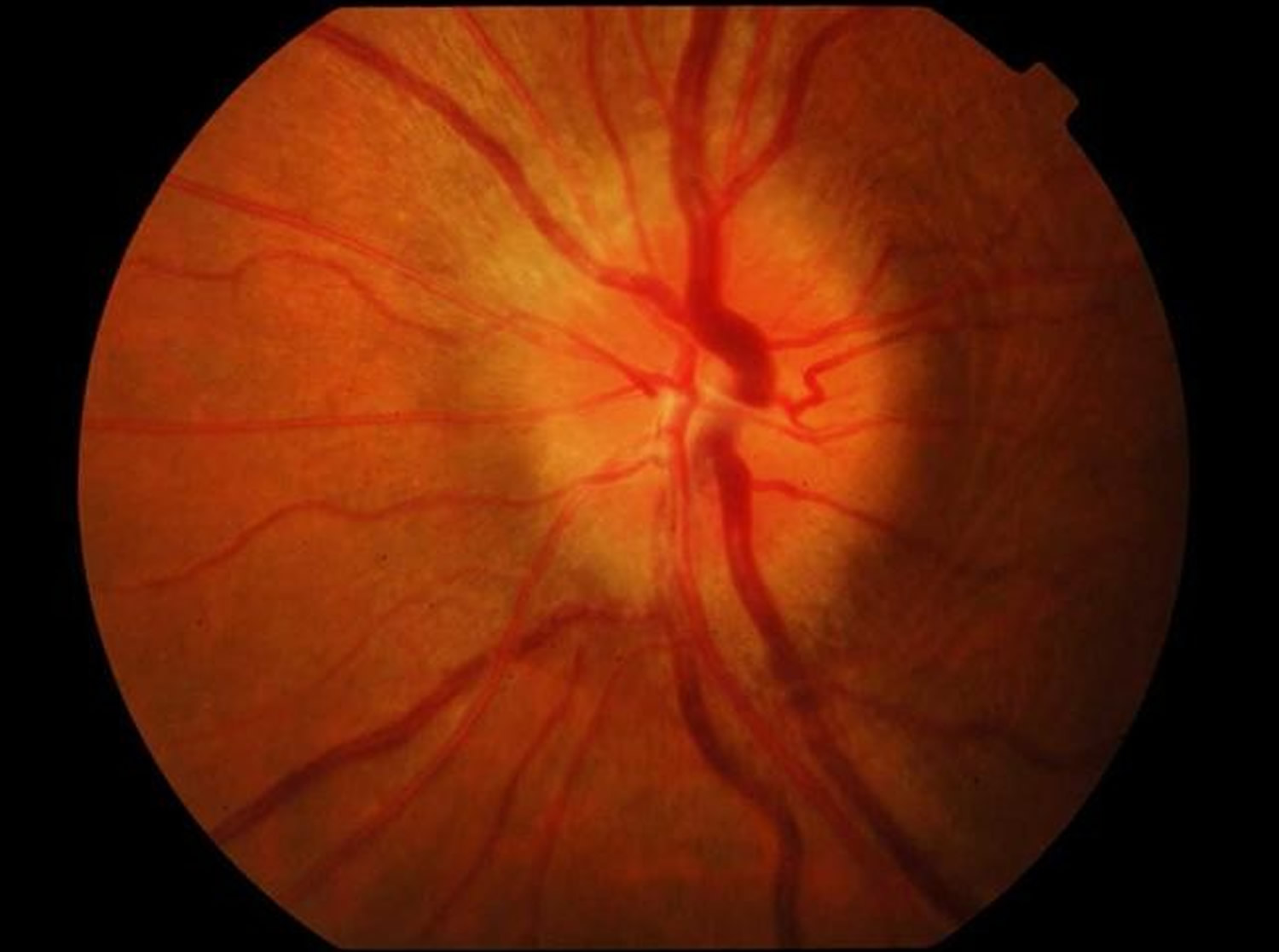 Optic Neuritis Causes Symptoms Prognosis Diagnosis Treatment