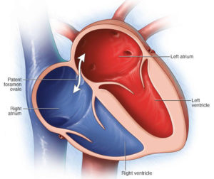 Patent Foramen Ovale - Causes, Symptoms, Diagnosis & Treatment