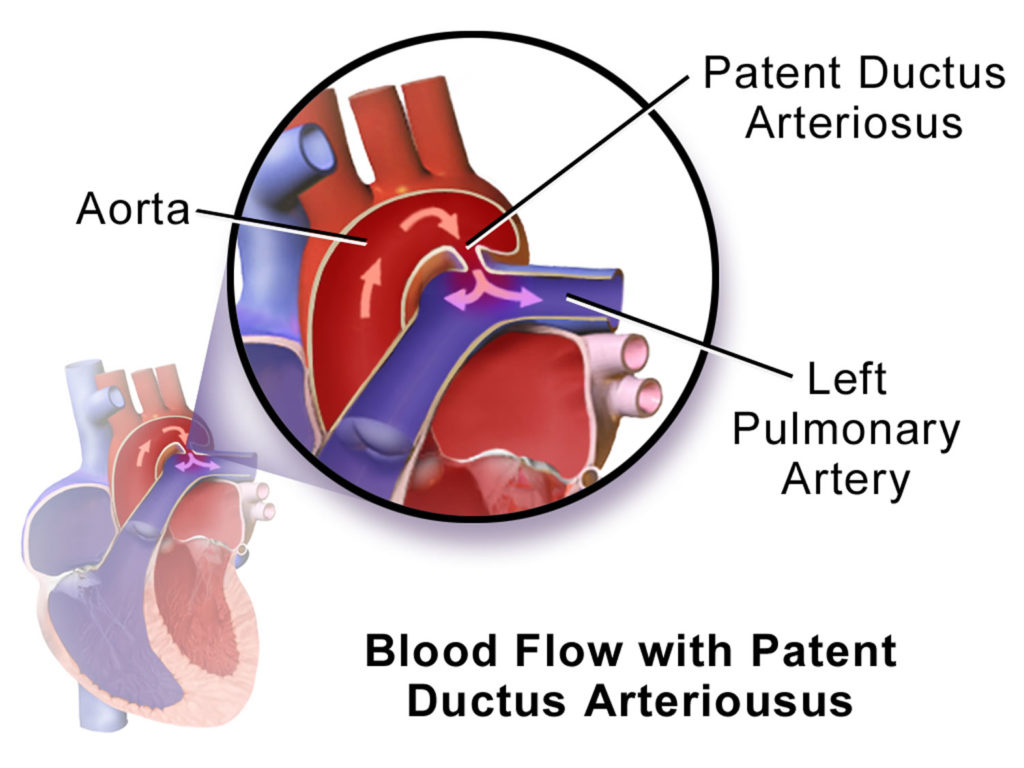 patent-ductus-arteriosus-causes-symptoms-diagnosis-treatment