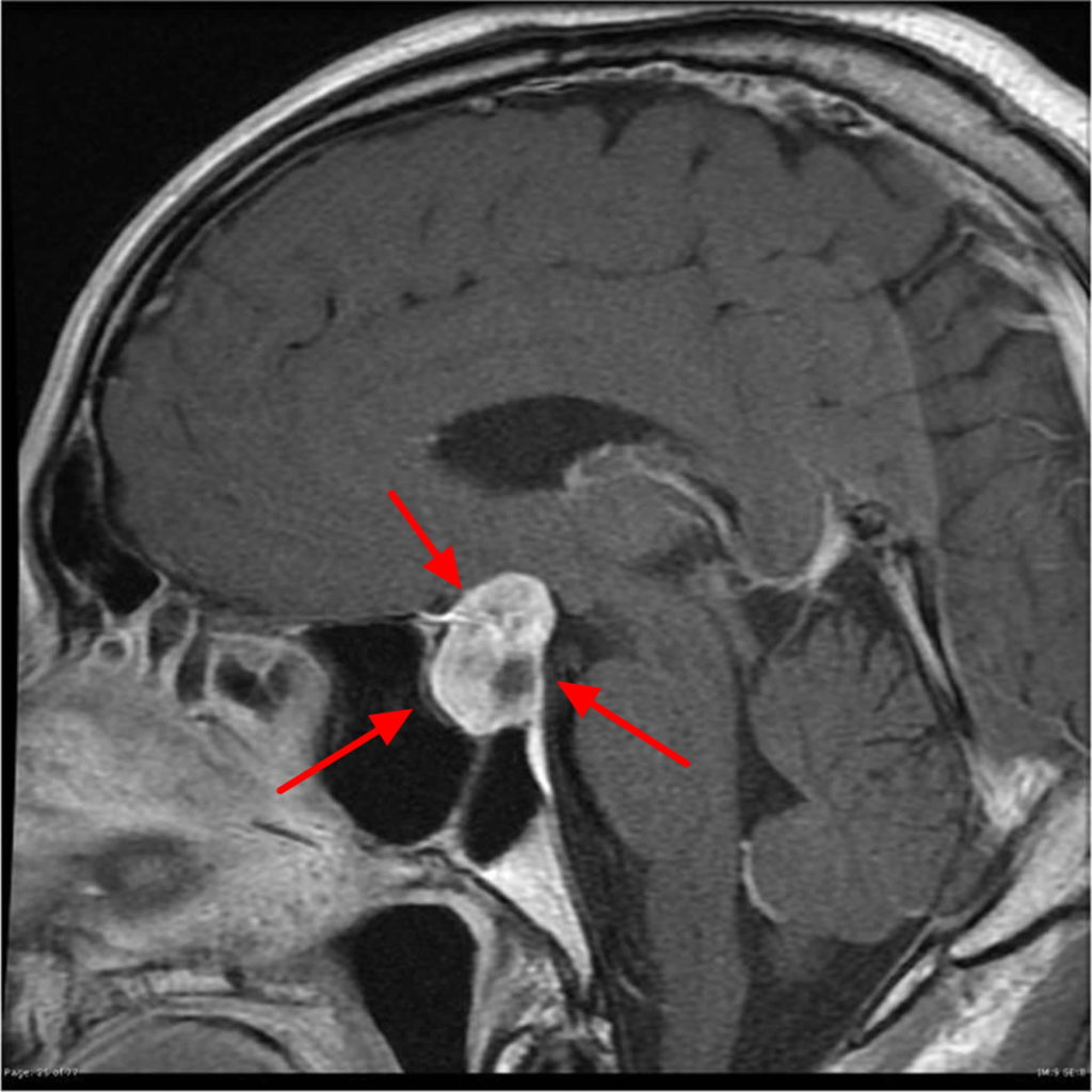 can-pituitary-tumor-be-cured-without-craniotomy-medical-news