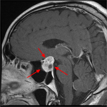 Pituitary Tumor - Signs, Symptoms, Diagnosis, MRI, Surgery & Treatment