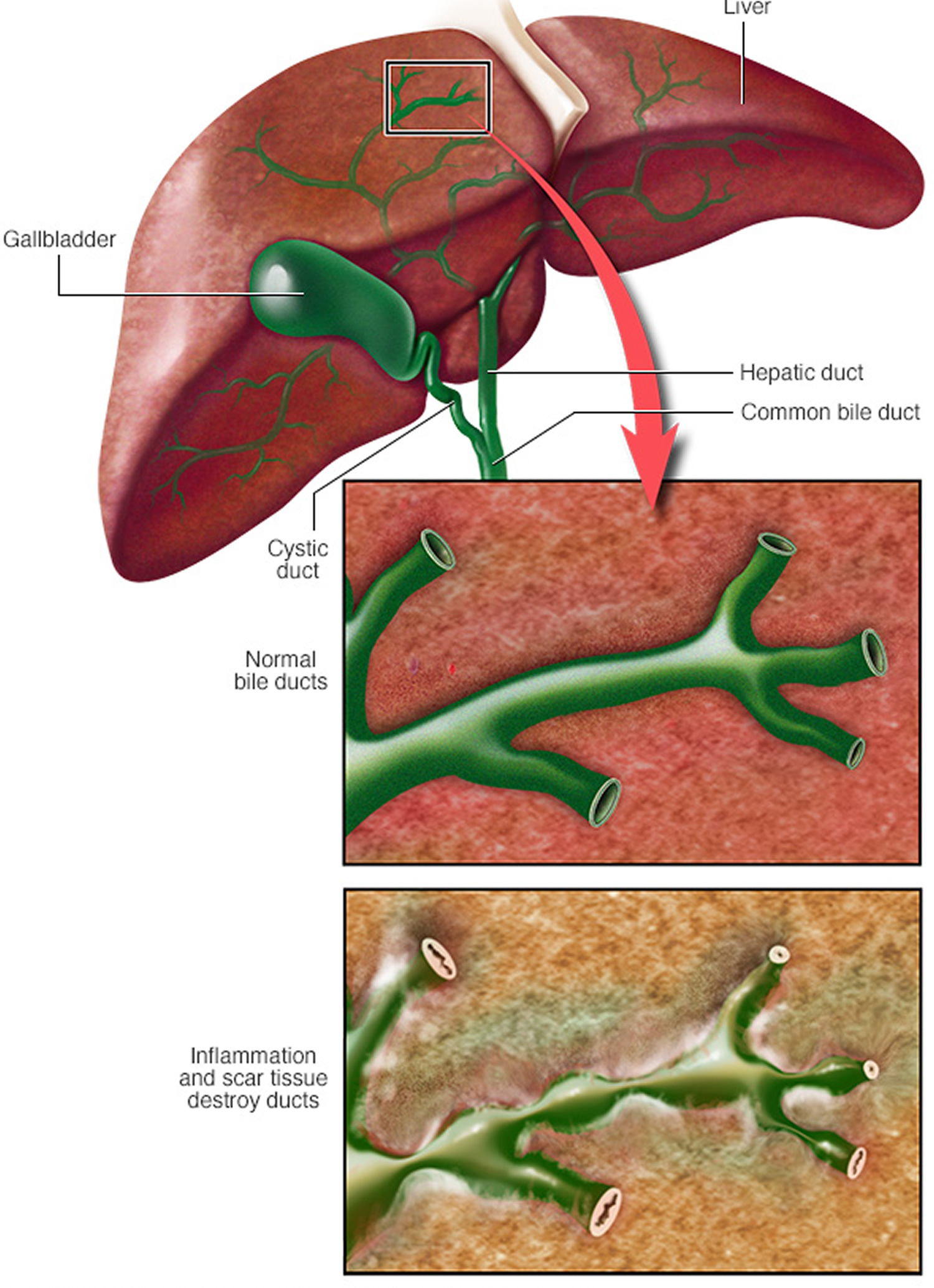 Primary Sclerosing Cholangitis - Causes, Symptoms, Prognosis, Treatment